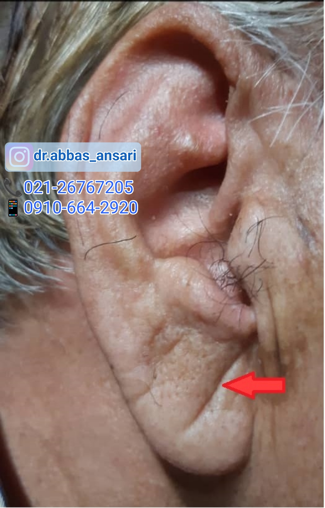 تشخیص بیماری عروق کرونر از طریق گوش- طب سوزنی دکتر انصاری