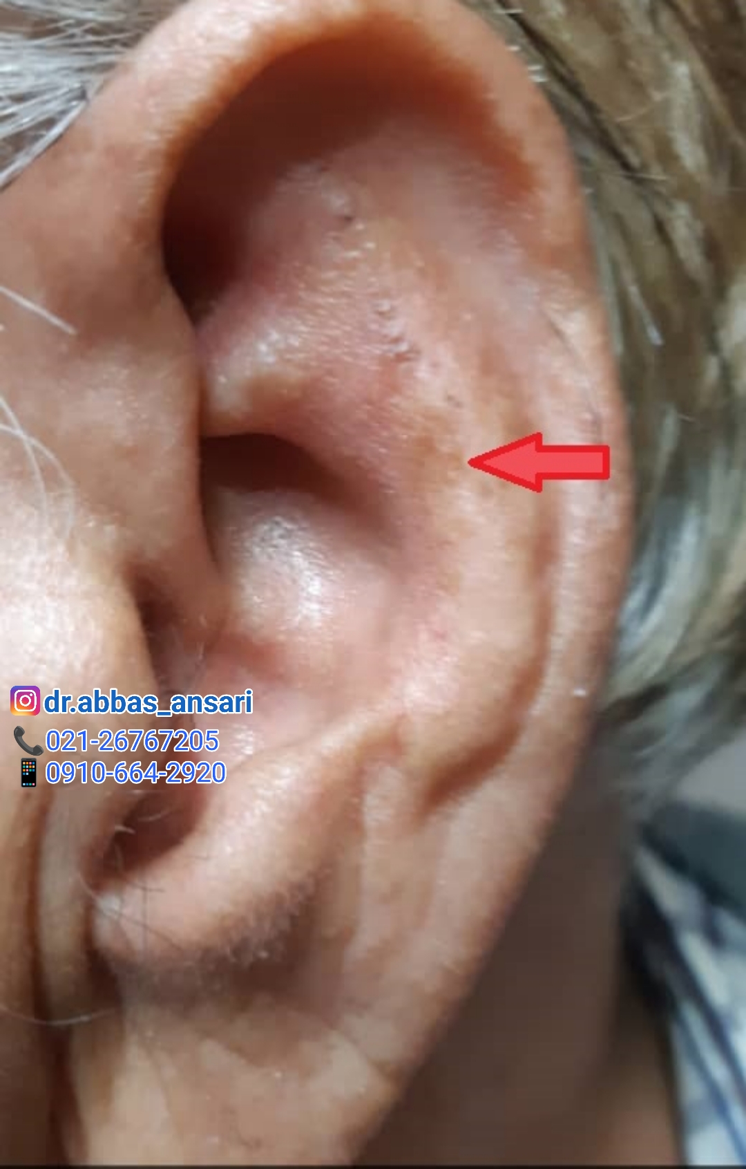 لکه روی گوش نشانه چیست؟ تشخیص از طریق گوش- طب سوزنی دکتر انصاری