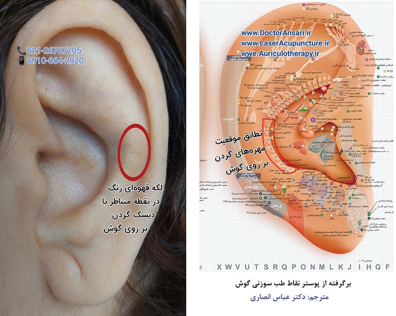 تشخیص دیسک گردن از روی لالۀ گوش