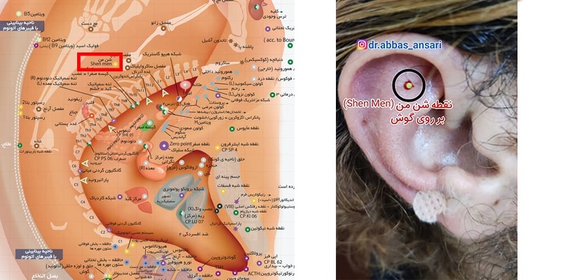 نمایش نقطه شن من (ShenMen) روی گوش بیمار - طب سوزنی دکتر انصاری
